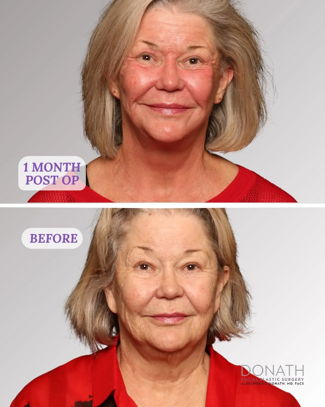 Before and after — Dr. Alexander Donath