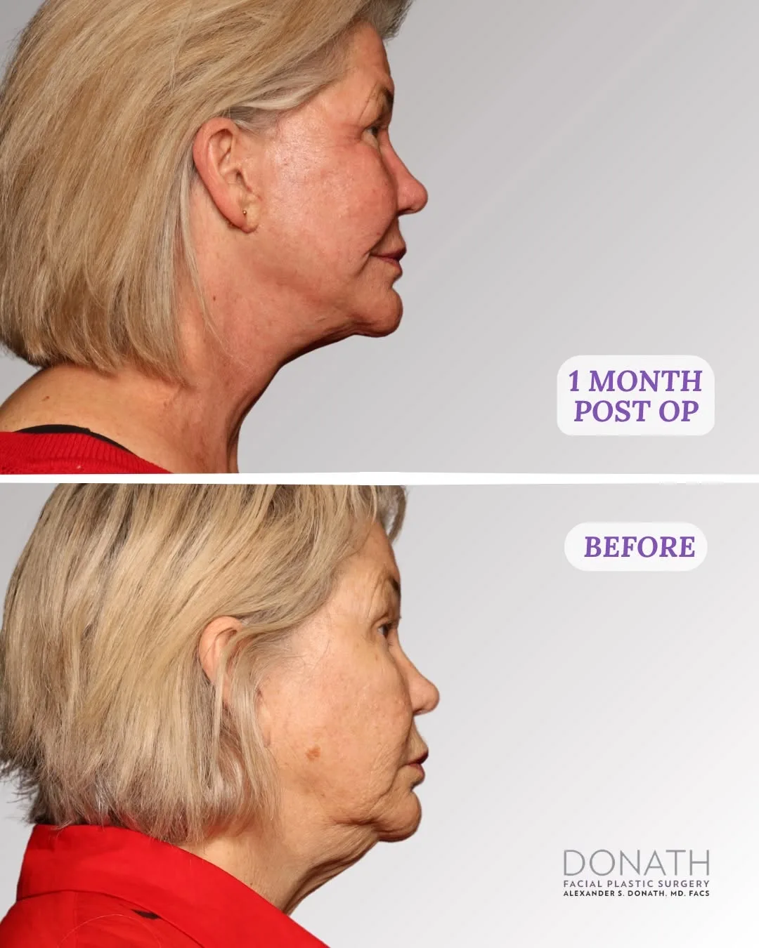 Before and after — Dr. Alexander Donath