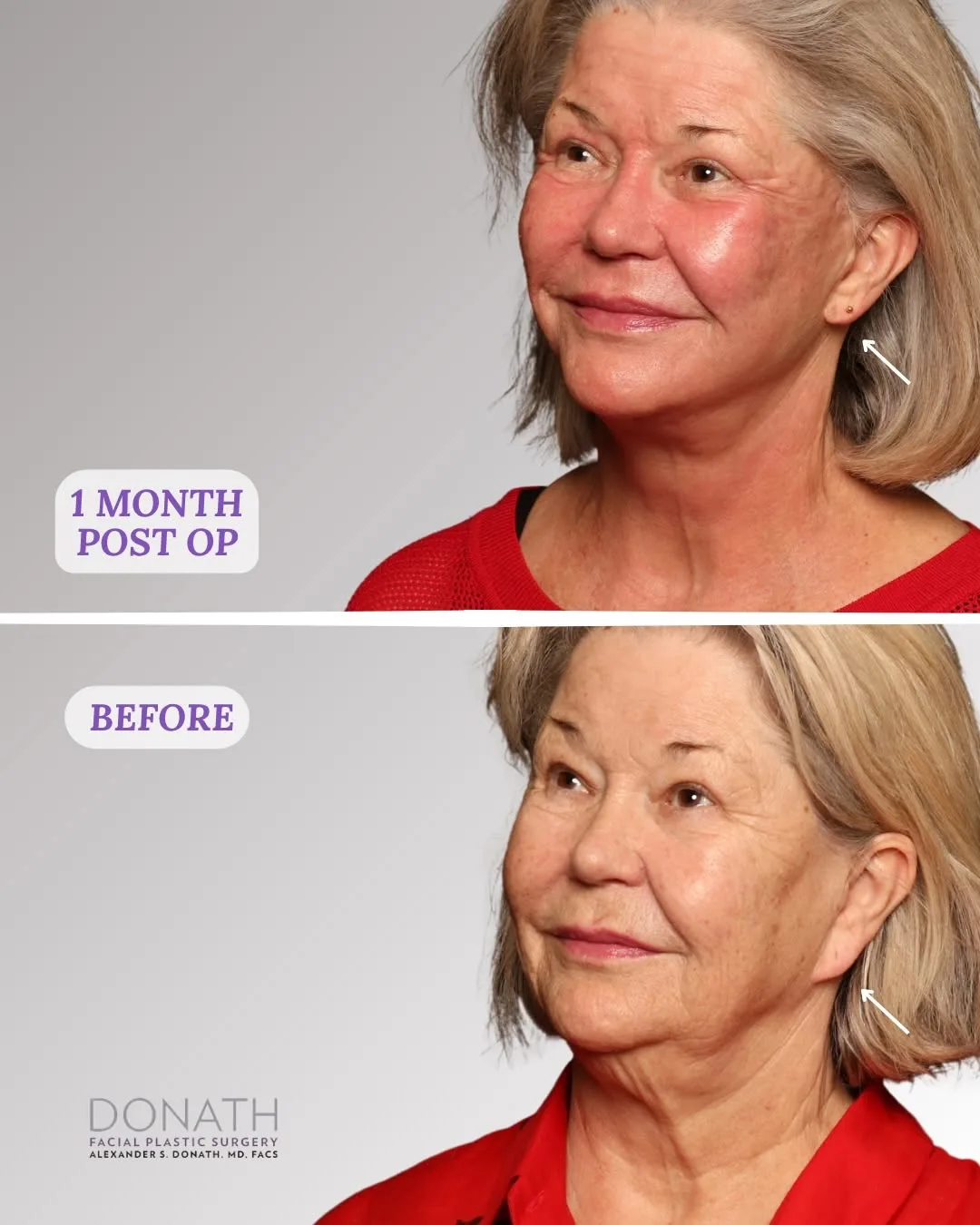 Before and after — Dr. Alexander Donath