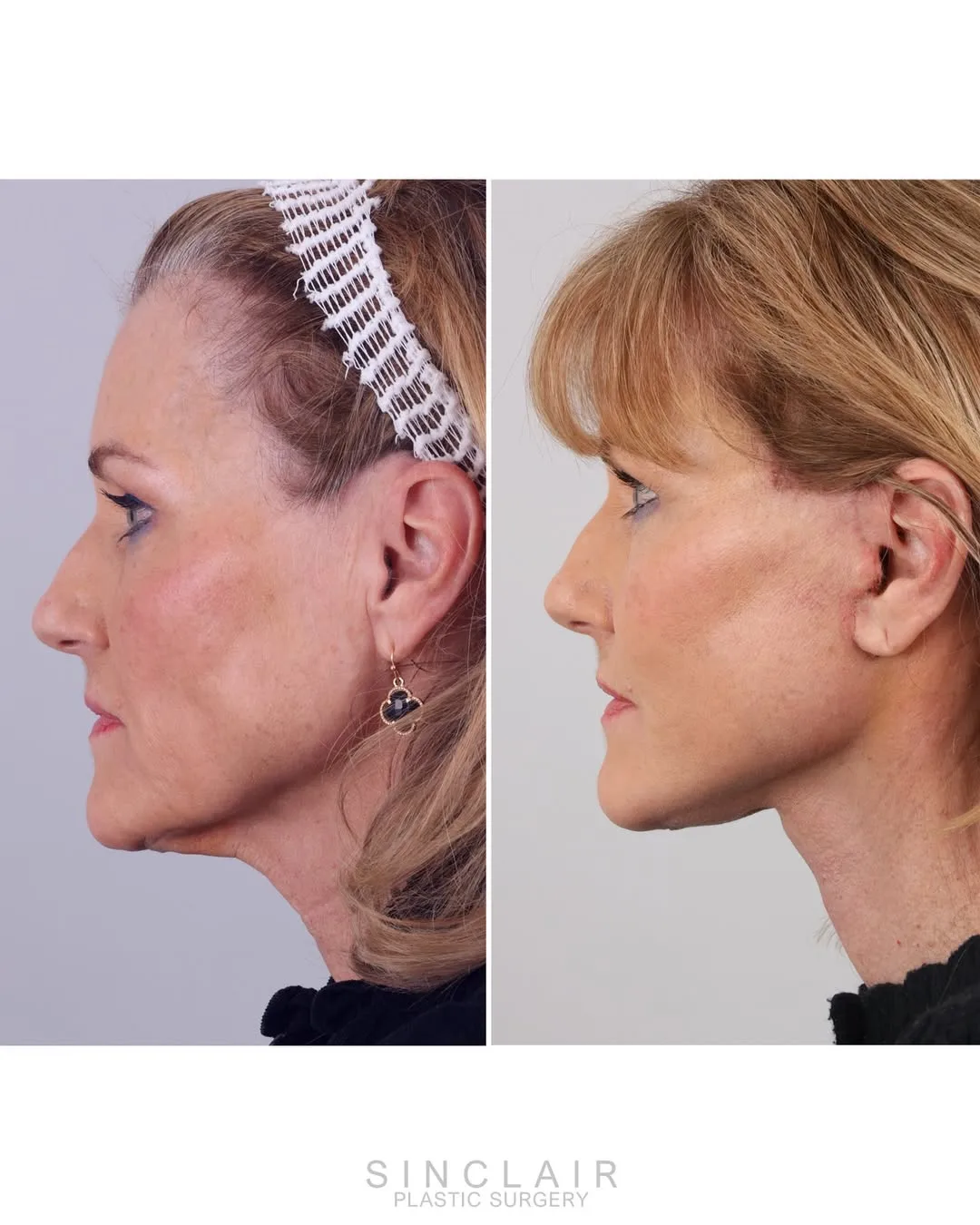 Before and after deep plane facelift — 52-year-old woman, right profile view, 6mo post-op by Dr. Alexander Sinclair