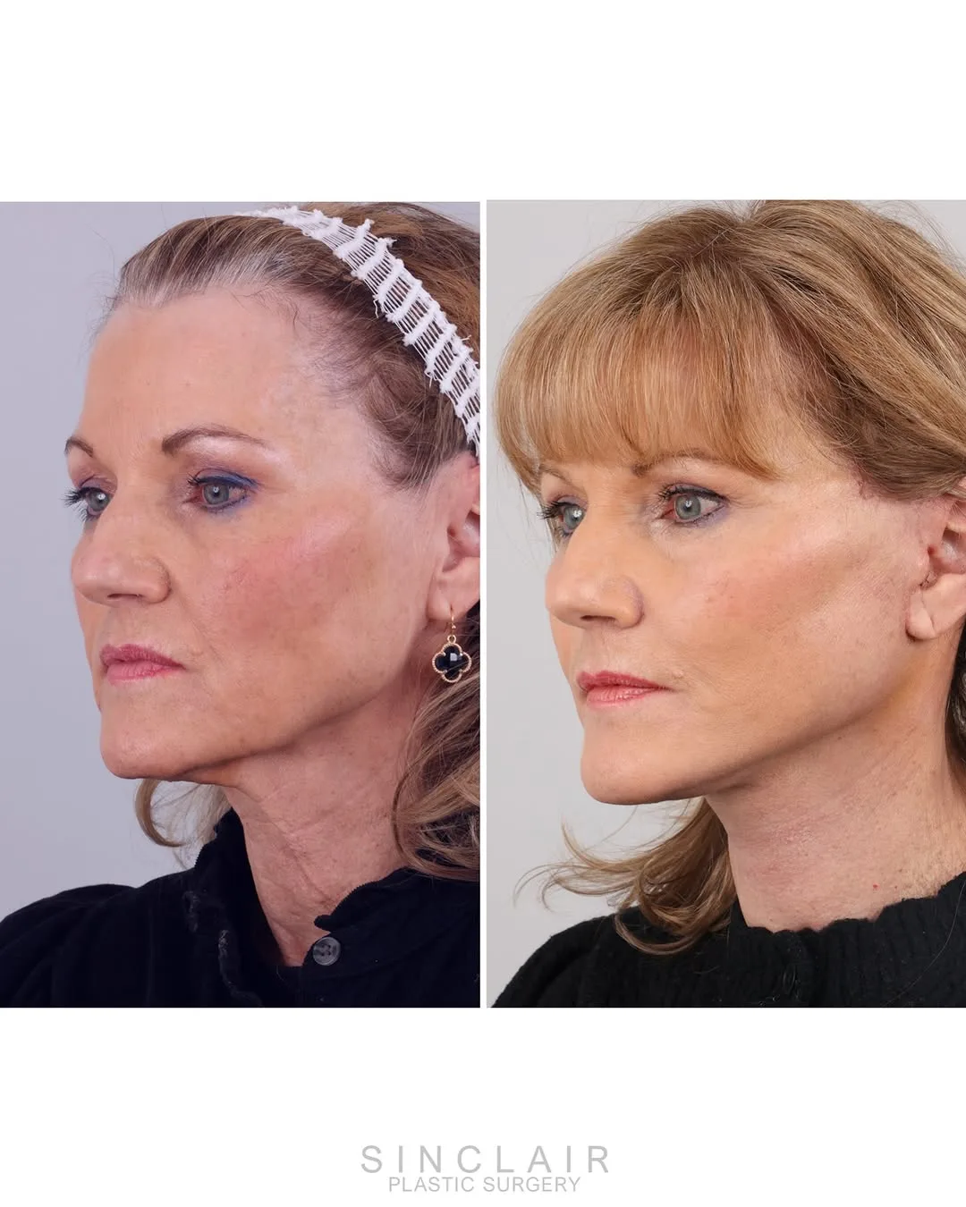Before and after deep plane facelift — 52-year-old woman, right profile view, 6mo post-op by Dr. Alexander Sinclair