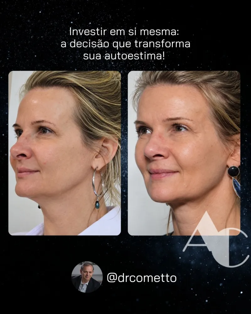 قبل وبعد - Deep Plane Facelift بواسطة د. Alexandre Cometto