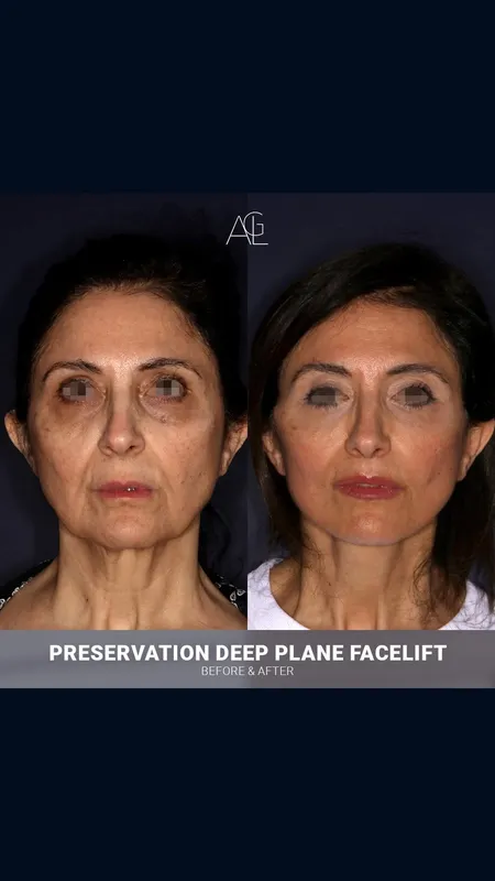 Before and after deep plane facelift, frontal view by Dr. Alexandre Lellouch