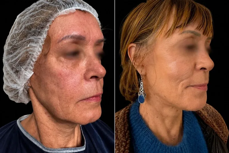 Before and after deep plane facelift, frontal view by Dr. Alexandre Lellouch