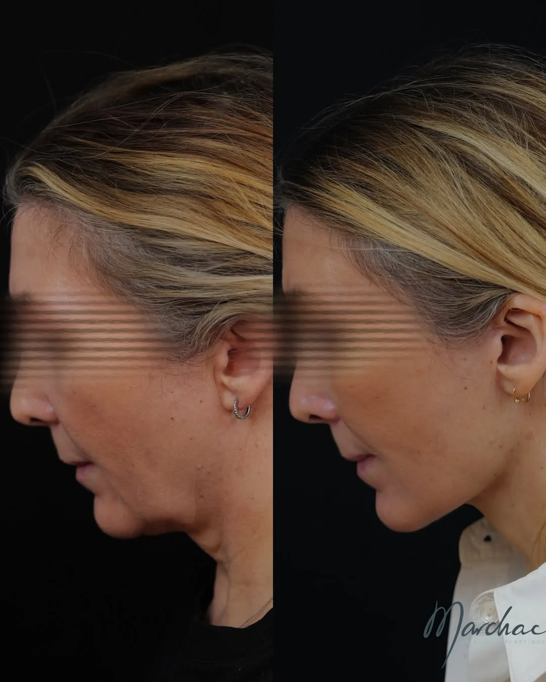 Before and after — Dr. Alexandre Marchac