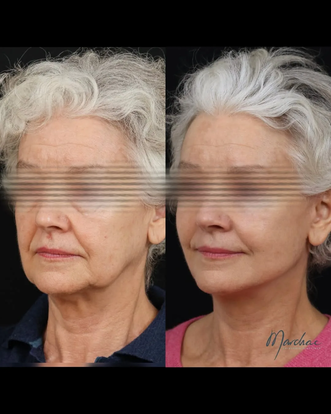 Before and after — Dr. Alexandre Marchac