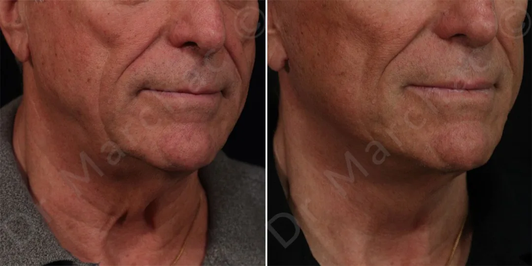 Before and after — Dr. Alexandre Marchac
