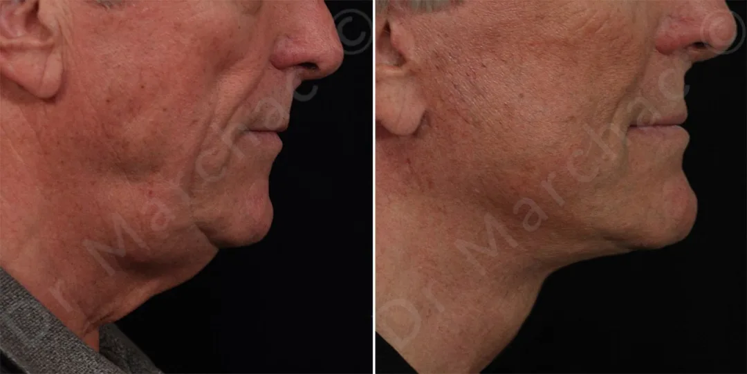 Before and after — Dr. Alexandre Marchac