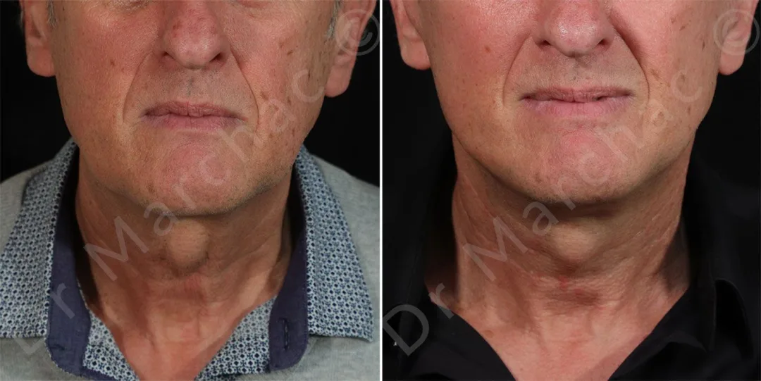 Before and after — Dr. Alexandre Marchac