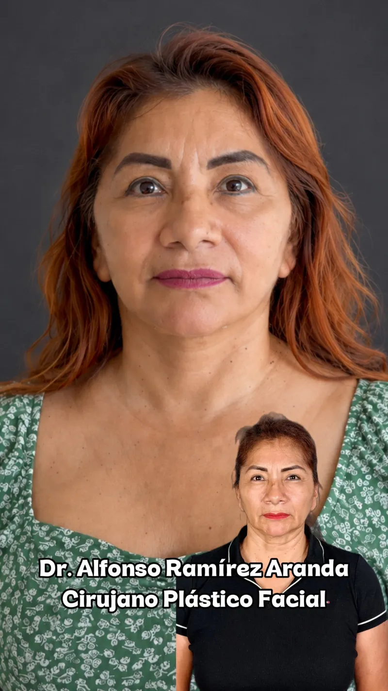 Before and after: Dr. Alfonso Ramírez Aranda
