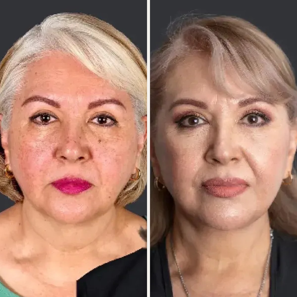 Before and after: Dr. Alfonso Ramírez Aranda