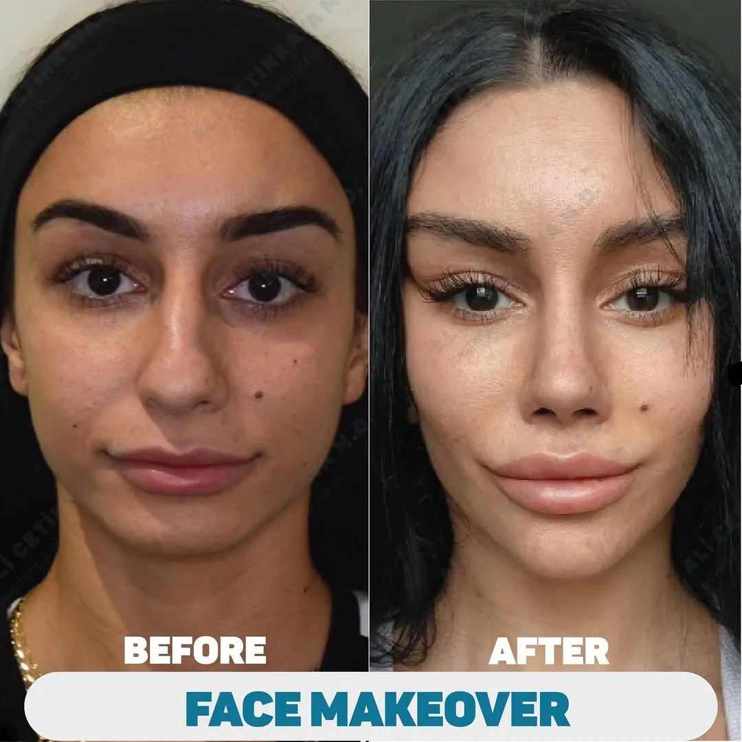 Before and after deep plane facelift — 28-year-old woman, frontal view, 6mo post-op by Dr. Ali Çetinkaya