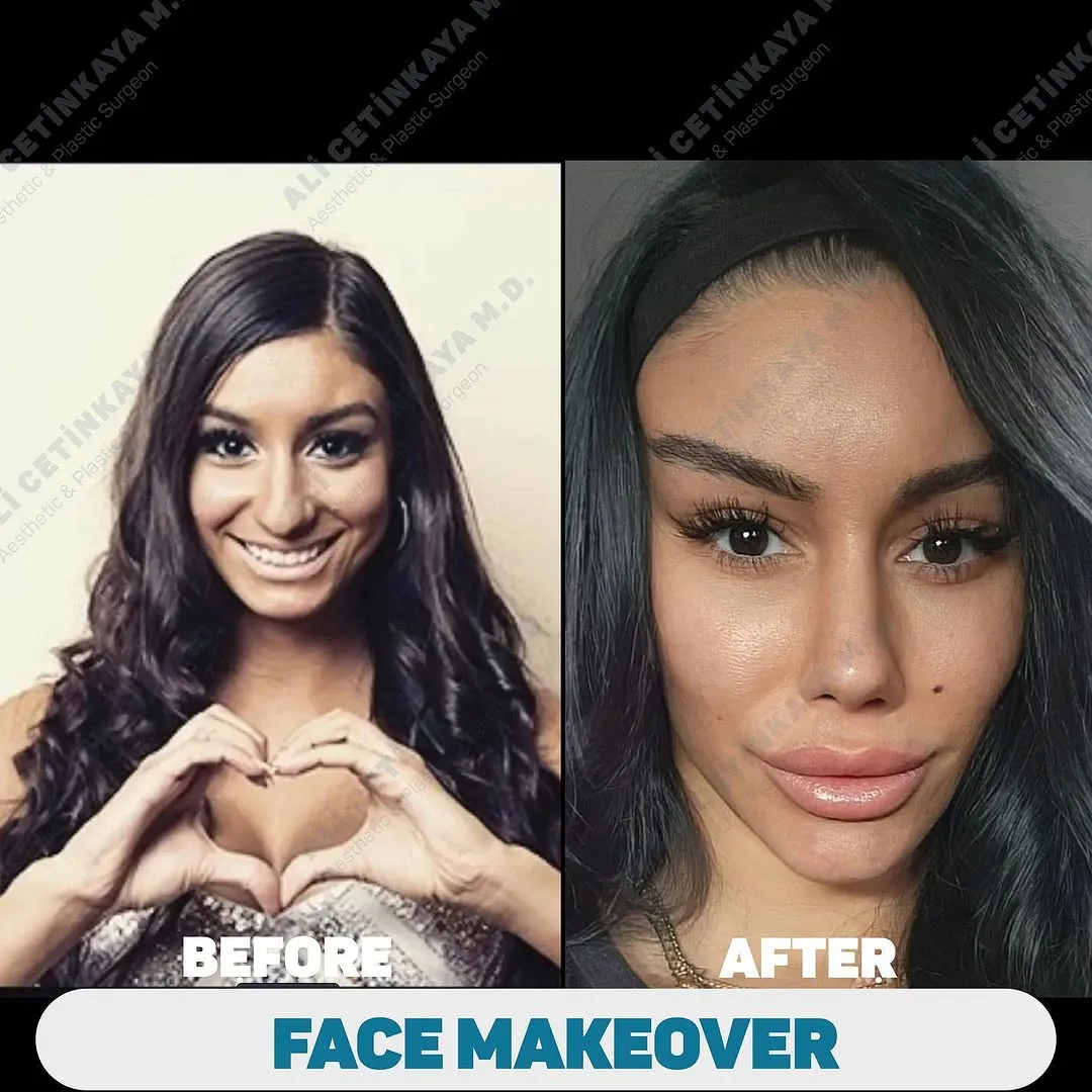 Before and after deep plane facelift — 25-year-old woman, oblique right view, 6mo post-op by Dr. Ali Çetinkaya
