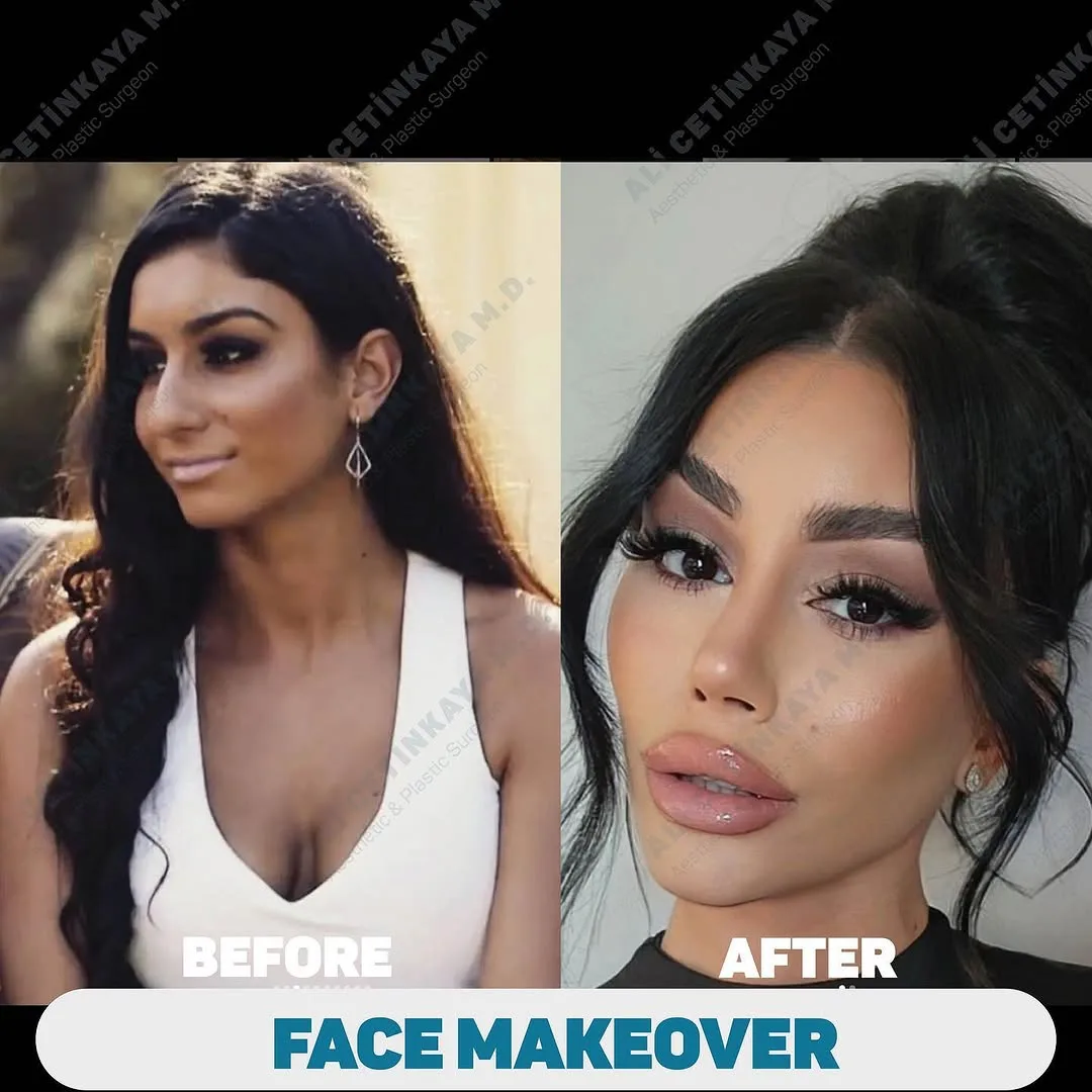 Before and after deep plane facelift — 28-year-old woman, oblique left view, 6mo post-op by Dr. Ali Çetinkaya