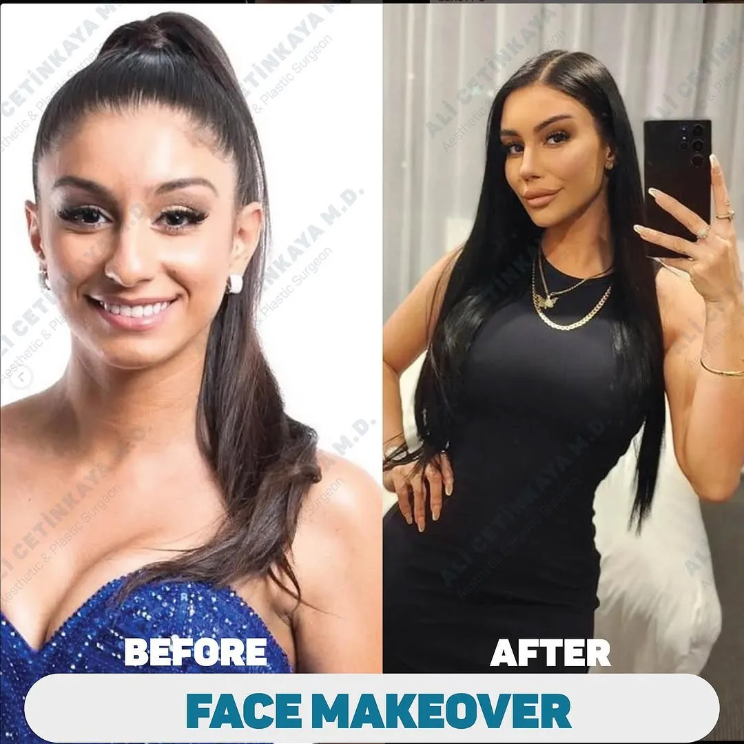 Before and after deep plane facelift — 26-year-old woman, three-quarter view, 12mo post-op by Dr. Ali Çetinkaya