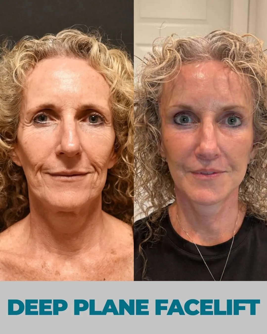 Before and after deep plane facelift — 58-year-old woman, frontal view, 6mo post-op by Dr. Ali Çetinkaya