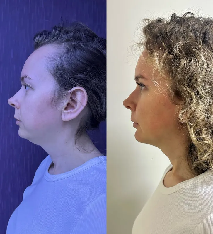 Before and after deep plane facelift — -1-year-old patient, frontal view by Dr. Ali Doğan