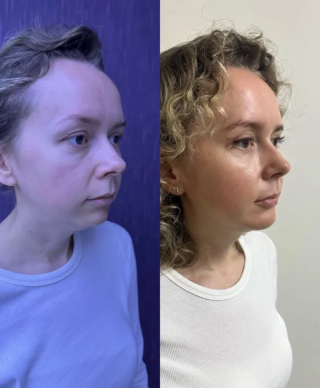 Before and after deep plane facelift — -1-year-old patient, frontal view by Dr. Ali Doğan
