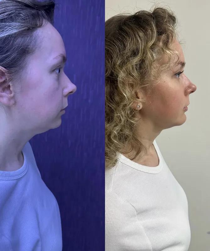Before and after deep plane facelift — -1-year-old patient, frontal view by Dr. Ali Doğan