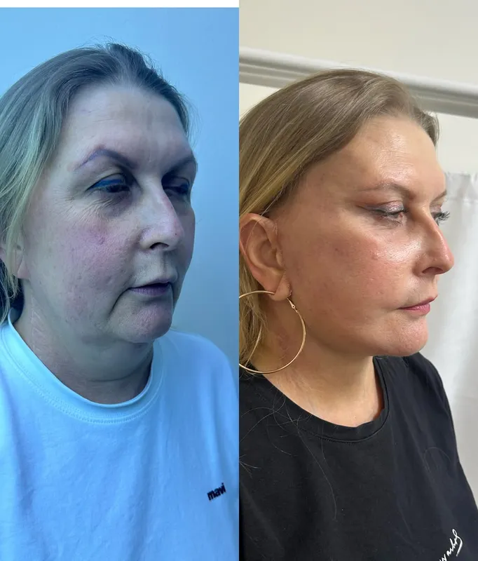 Before and after deep plane facelift — -1-year-old patient, frontal view by Dr. Ali Doğan