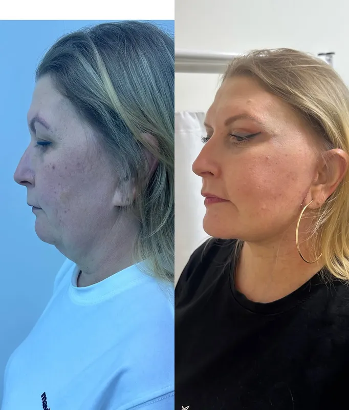 Before and after deep plane facelift — -1-year-old patient, frontal view by Dr. Ali Doğan