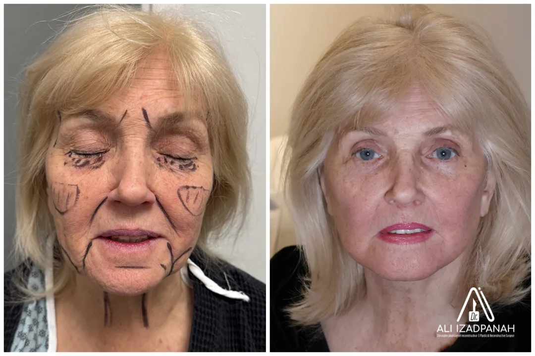 Before and after: Dr. Ali Izadpanah