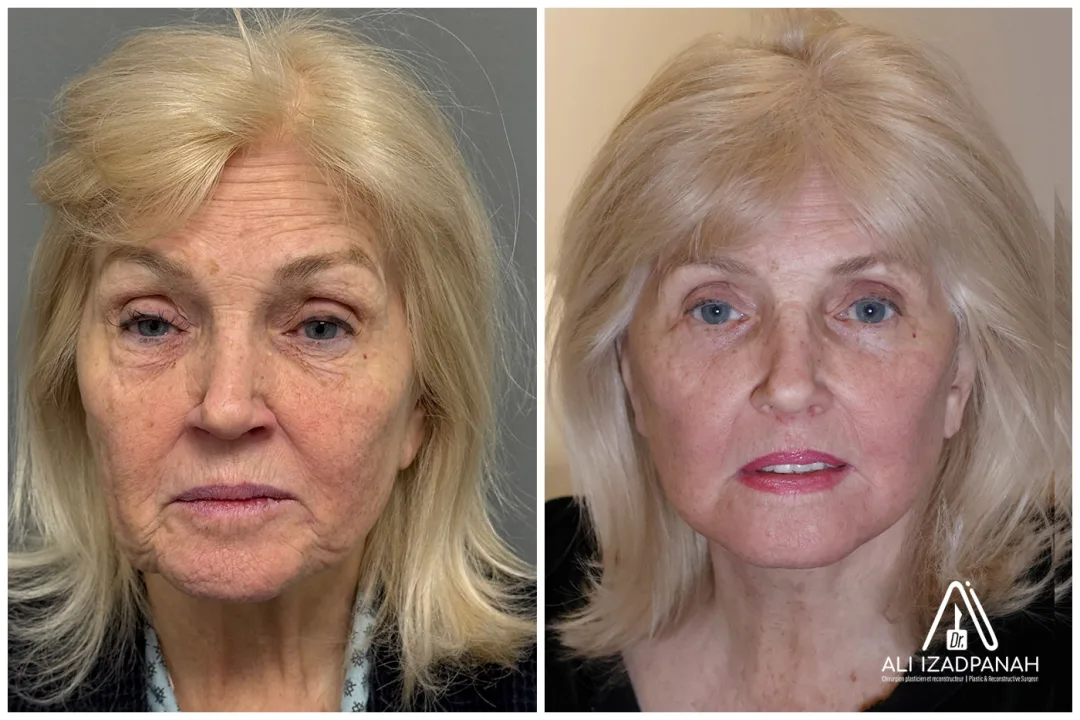 Before and after: Dr. Ali Izadpanah