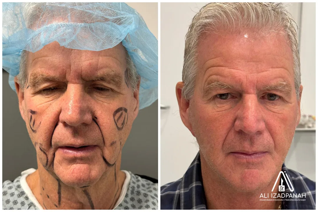 Before and after: Dr. Ali Izadpanah