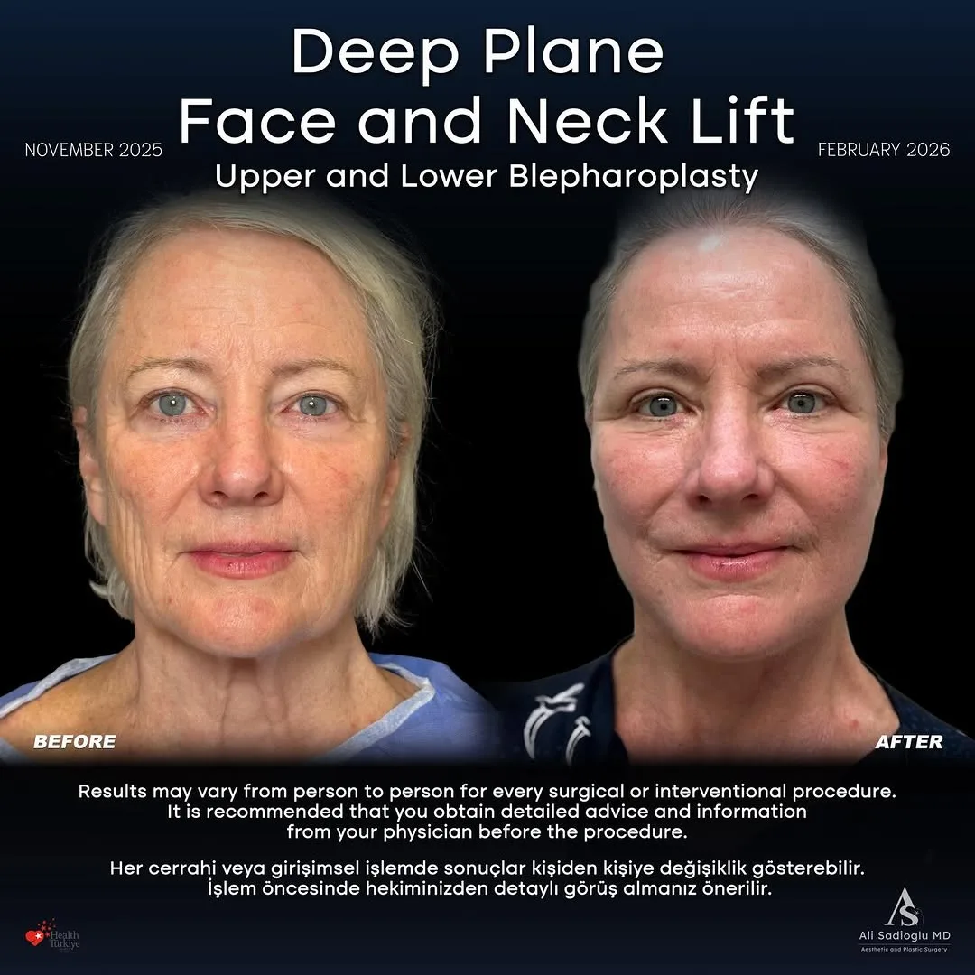 Before and after — Dr. Ali Sadıoğlu
