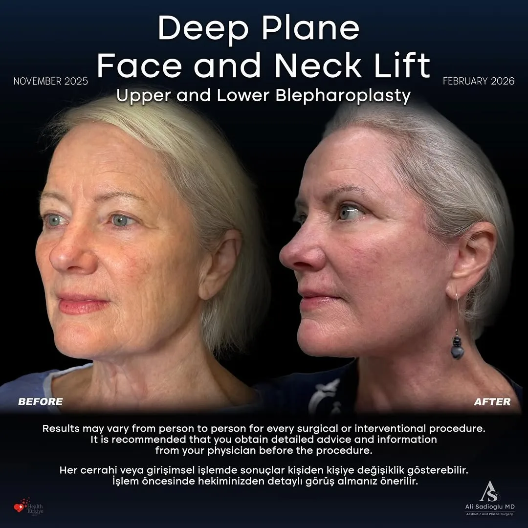 Before and after — Dr. Ali Sadıoğlu