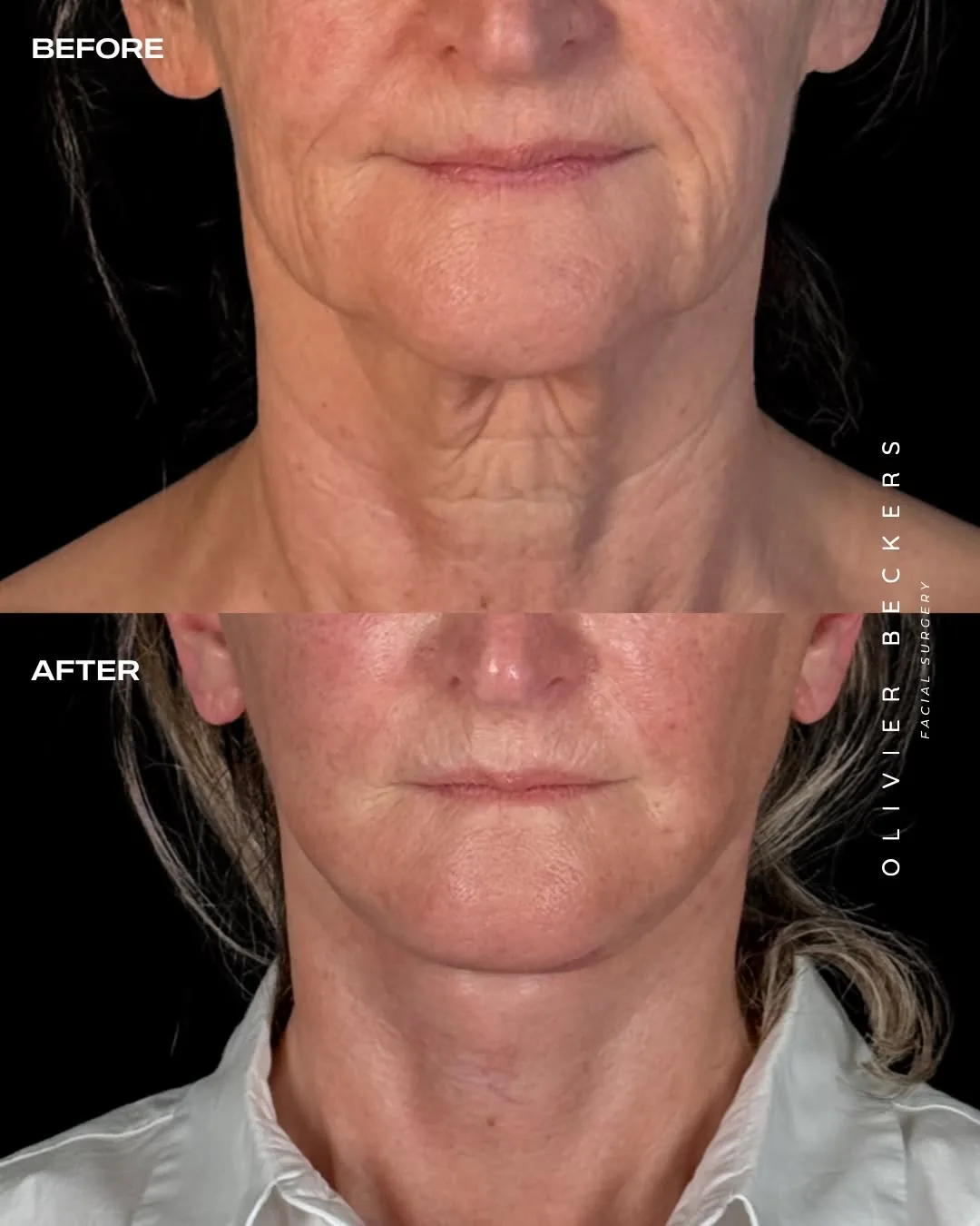 Before and after deep plane facelift — 58-year-old woman, frontal view, 1mo post-op by Dr. Aljoscha Becker