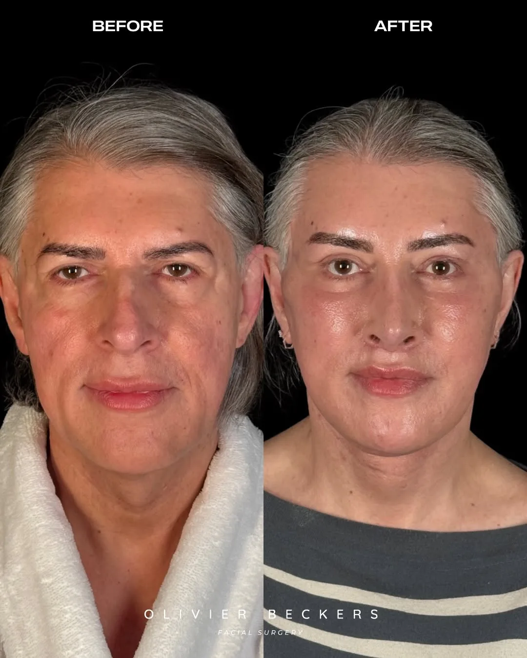 Before and after deep plane facelift — 55-year-old woman, frontal view, 6mo post-op by Dr. Aljoscha Becker
