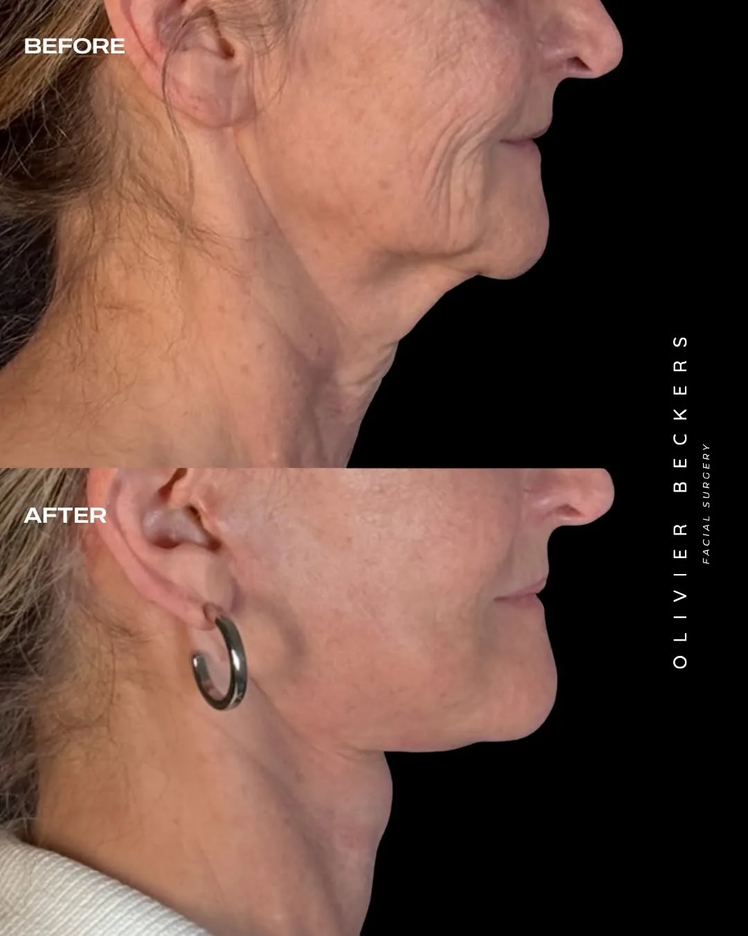 Before and after deep plane facelift — 65-year-old woman, three-quarter view, 1mo post-op by Dr. Aljoscha Becker