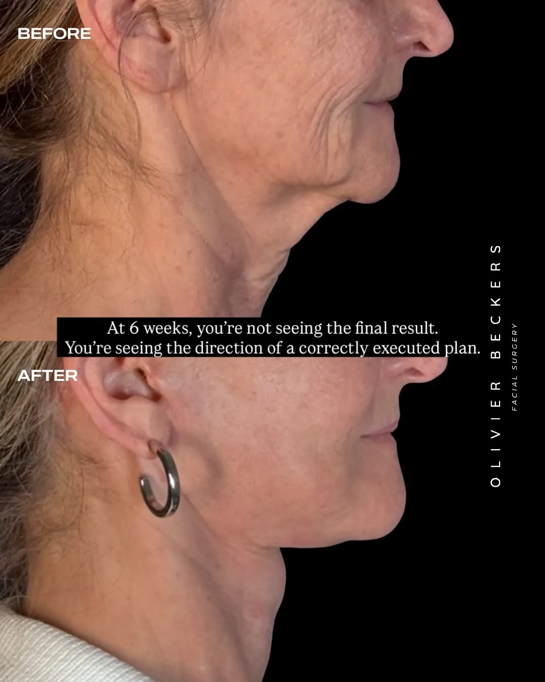 Before and after deep plane facelift — 62-year-old woman, right profile view, 1mo post-op by Dr. Aljoscha Becker