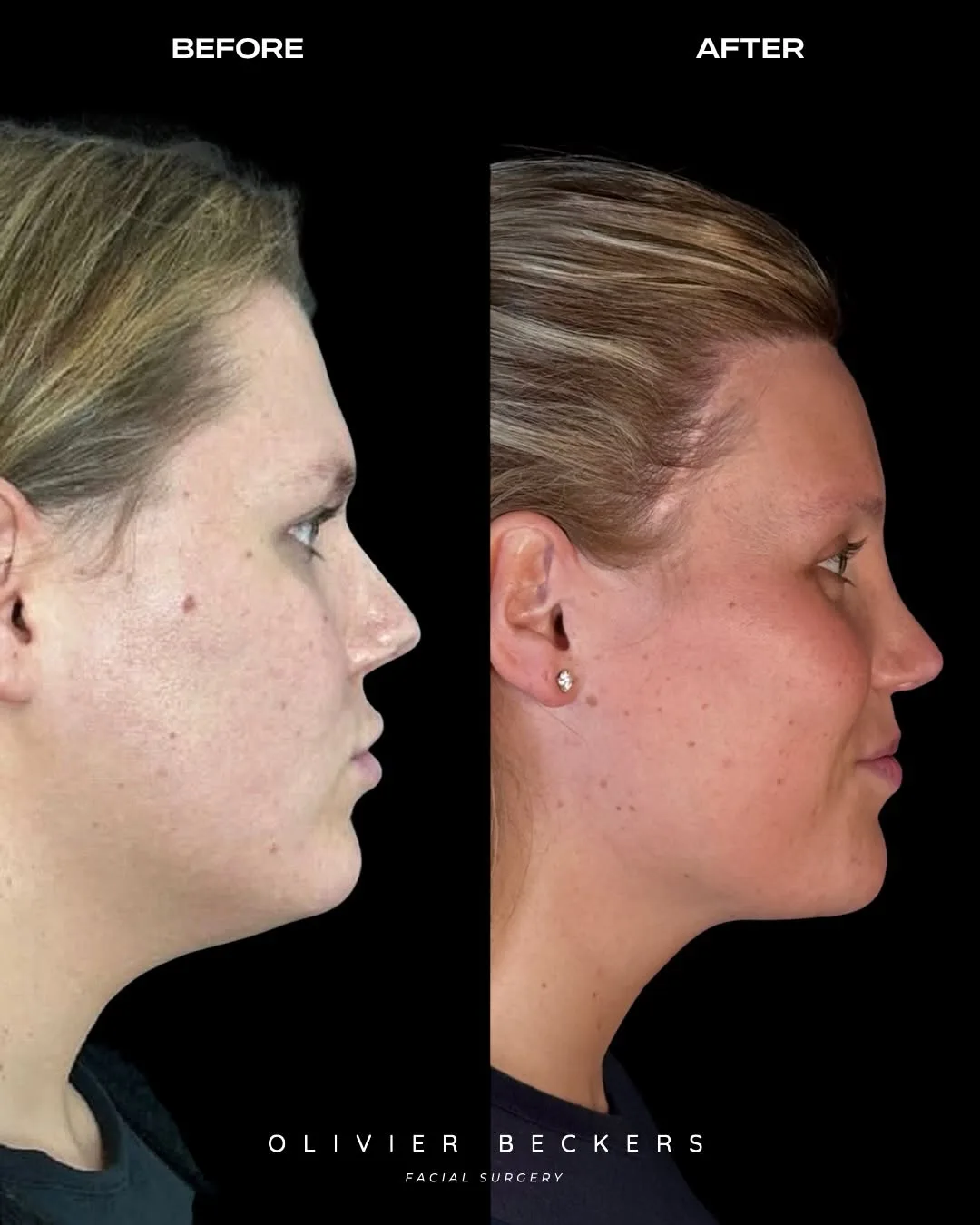 Before and after deep plane facelift — 45-year-old woman, right profile view, 6mo post-op by Dr. Aljoscha Becker