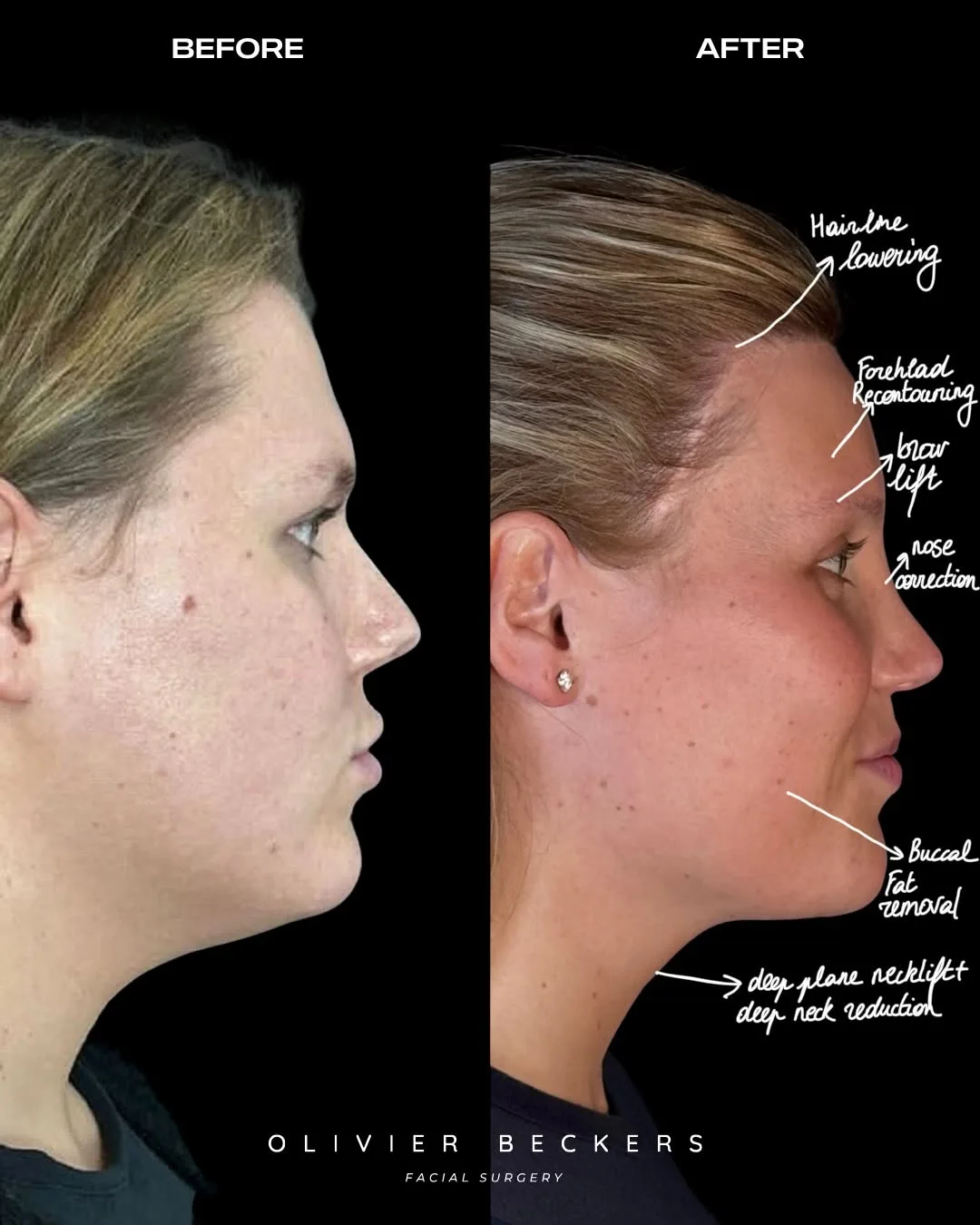 Before and after deep plane facelift — 42-year-old woman, right profile view, 6mo post-op by Dr. Aljoscha Becker
