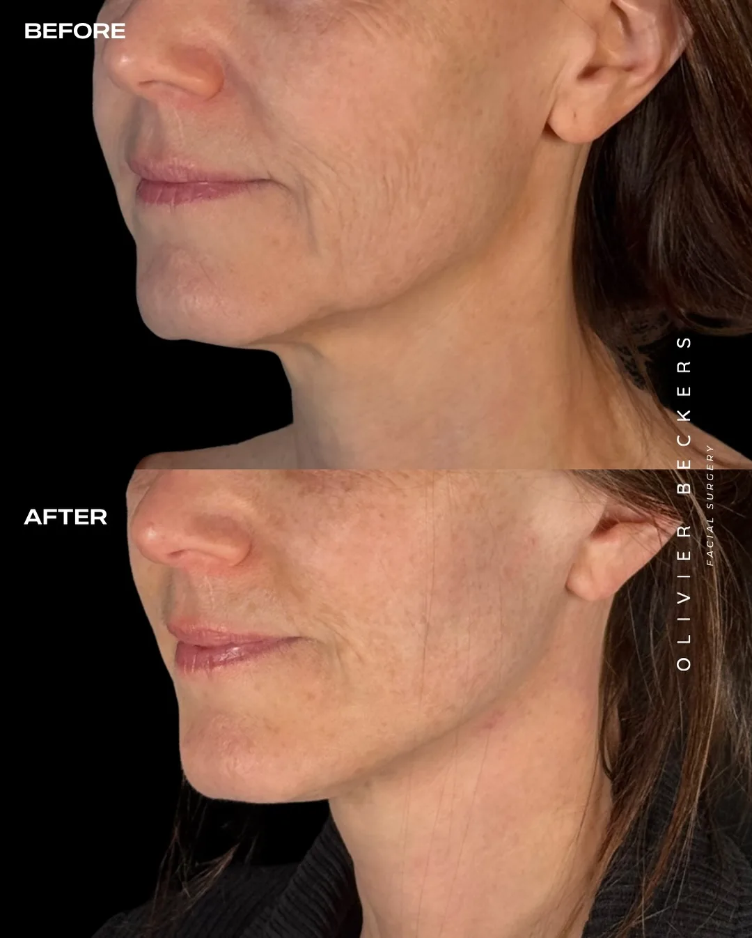 Before and after deep plane facelift — 55-year-old woman, three-quarter view, 5mo post-op by Dr. Aljoscha Becker