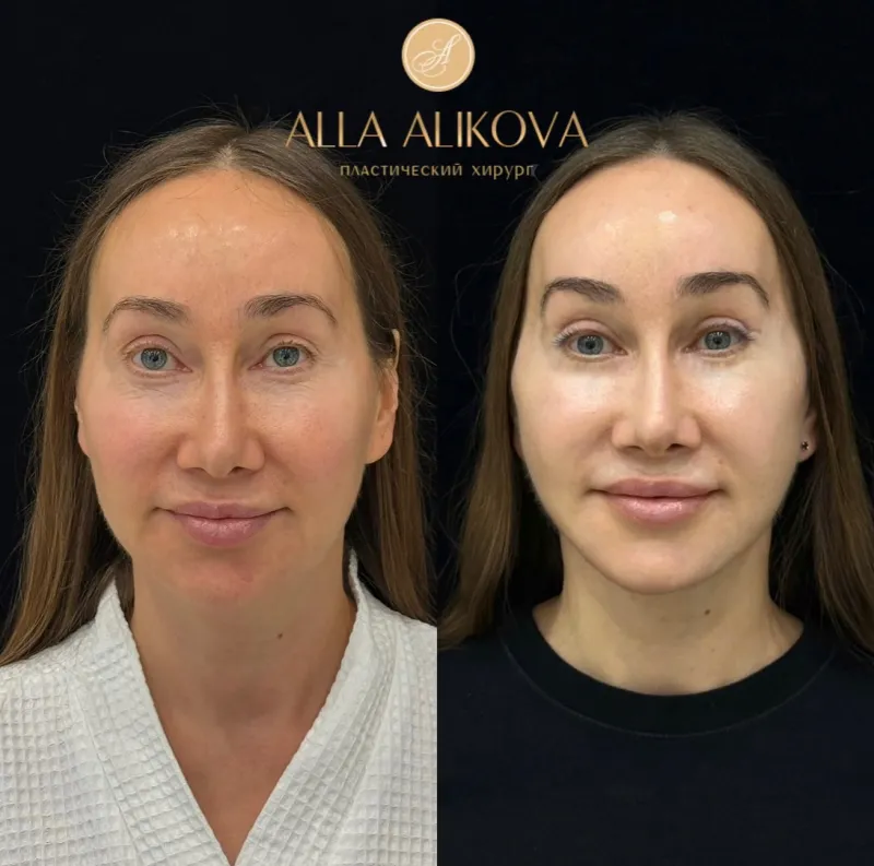 Before and after — Dr. Alla Alikova