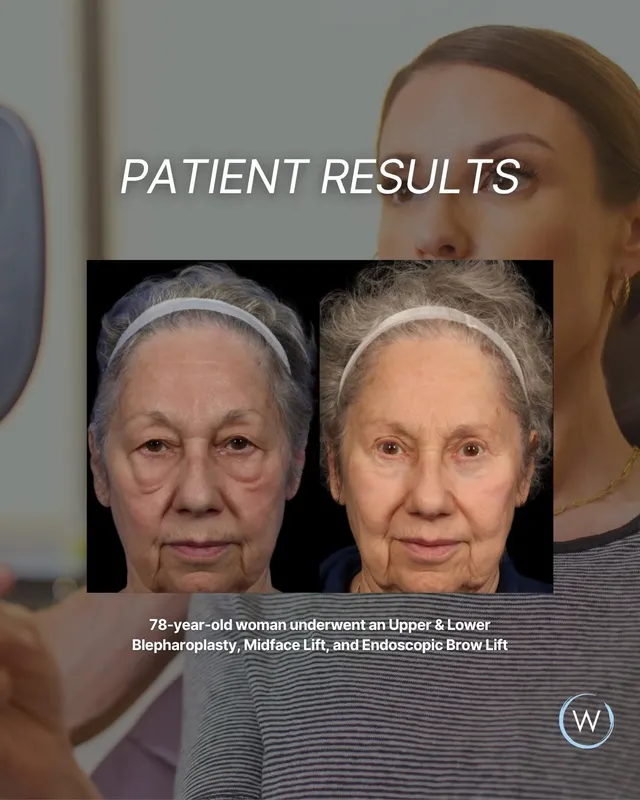 Before and after — Dr. Allan Wulc