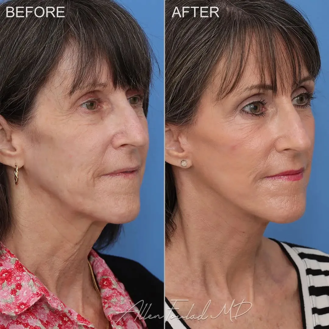 Before and after — Dr. Allen Foulad