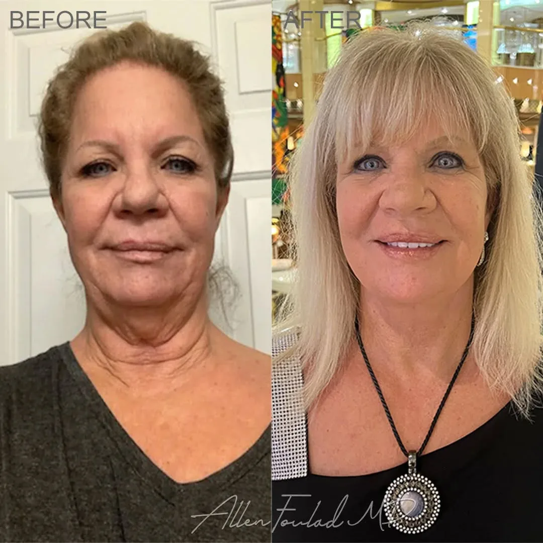 Before and after — Dr. Allen Foulad