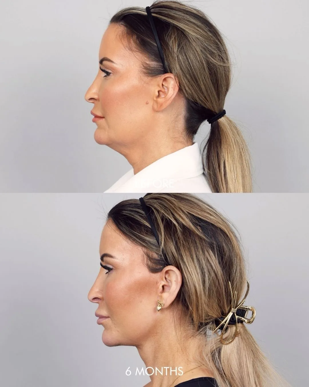 Before and after deep plane facelift — 45-year-old woman, left profile view, 6mo post-op by Dr. Amir Nakhdjevani