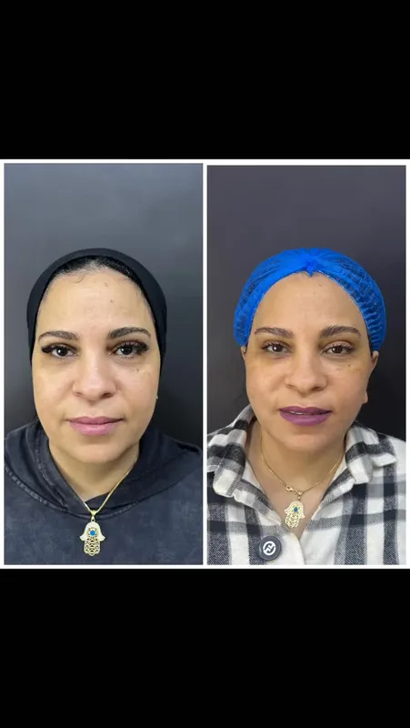 Before and after deep plane facelift — -1-year-old patient, frontal view by Dr. Amr Adel
