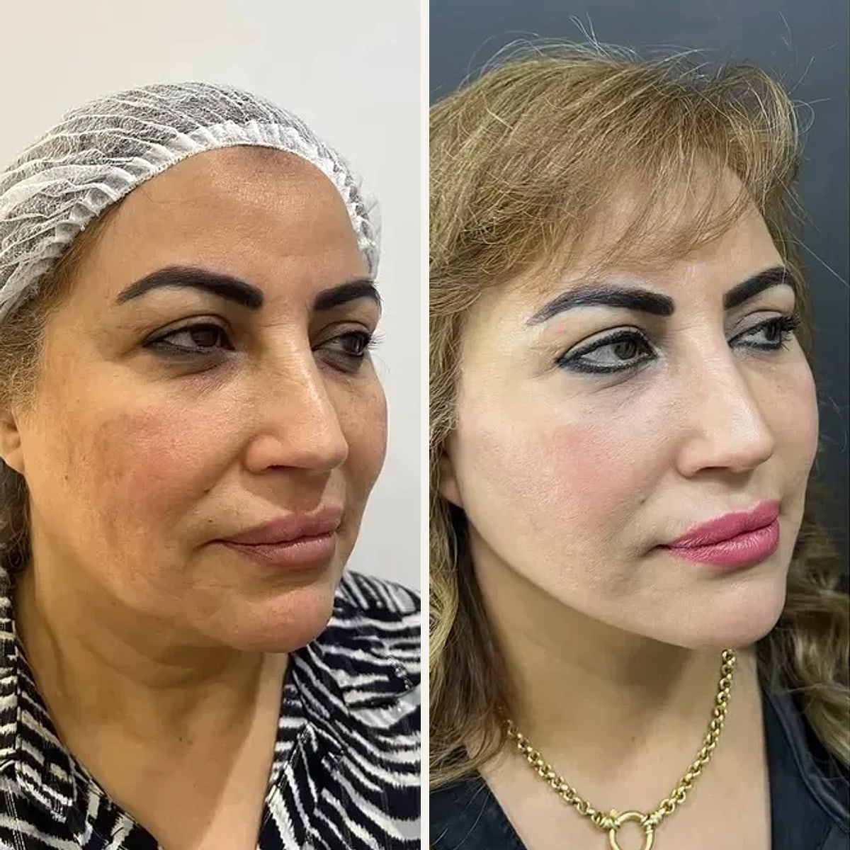 Before and after: Dr. Amr Adel