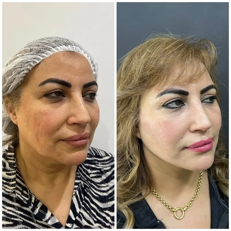 Before and after deep plane facelift — -1-year-old patient, frontal view by Dr. Amr Adel