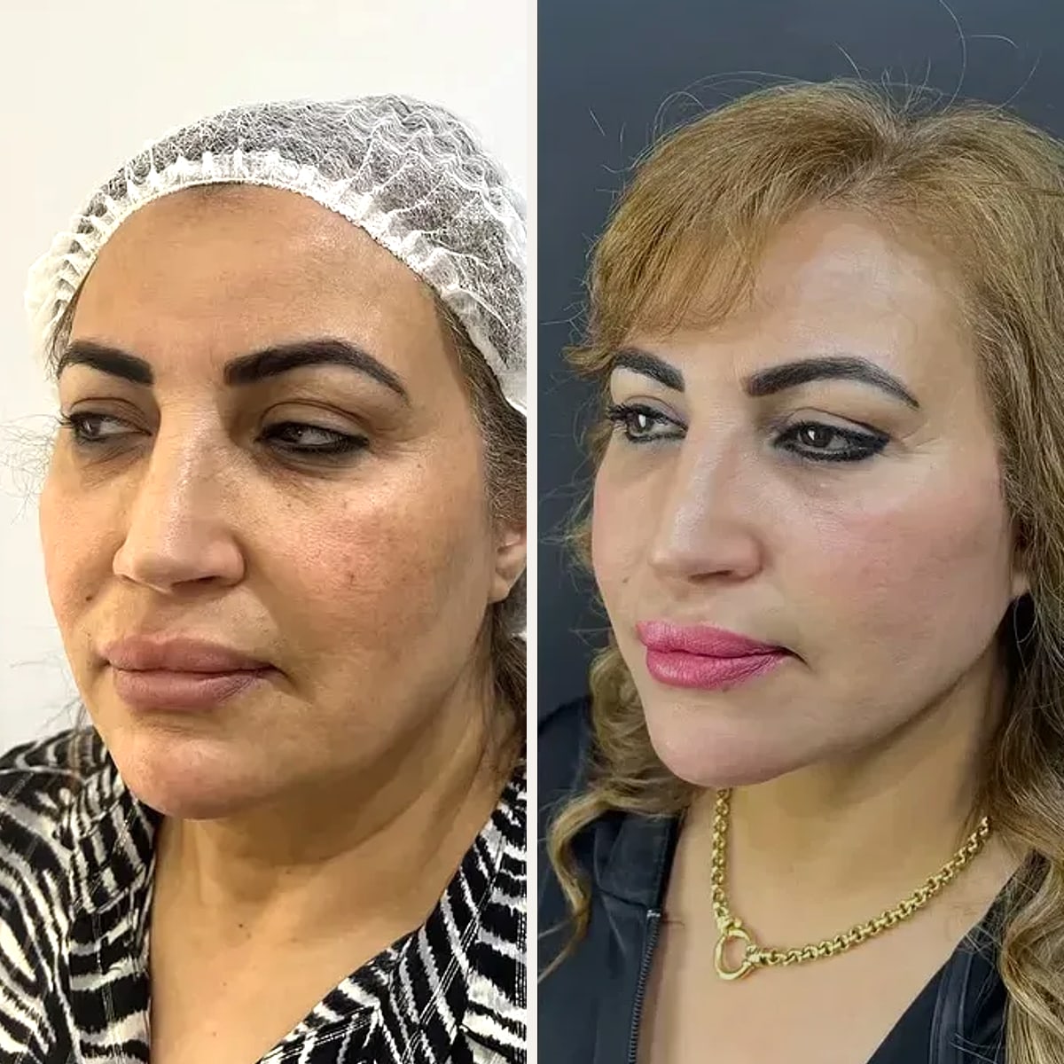 Before and after: Dr. Amr Adel