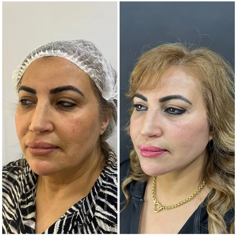 Before and after deep plane facelift — -1-year-old patient, frontal view by Dr. Amr Adel