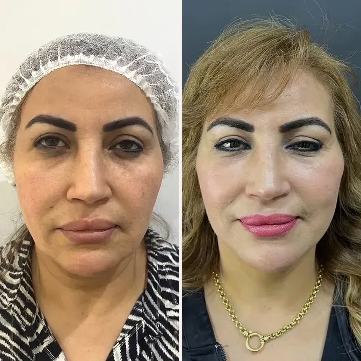 Before and after: Dr. Amr Adel