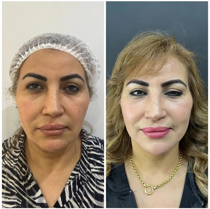 Before and after deep plane facelift — -1-year-old patient, frontal view by Dr. Amr Adel