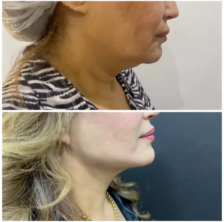 Before and after deep plane facelift — -1-year-old patient, frontal view by Dr. Amr Adel